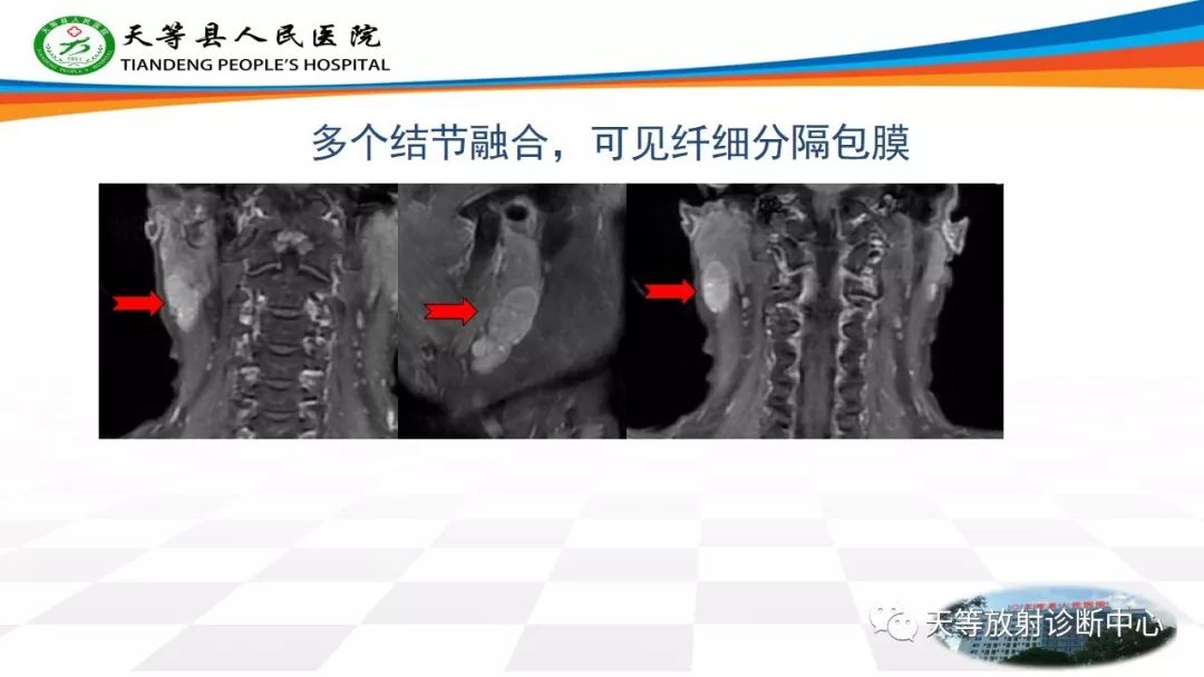 影像PPT - 【病例】腮腺Warthin瘤(腺淋巴瘤)1例CT影像-49 影像PPT - 【病例】腮腺Warthin瘤(腺淋巴瘤)1例CT影像-49