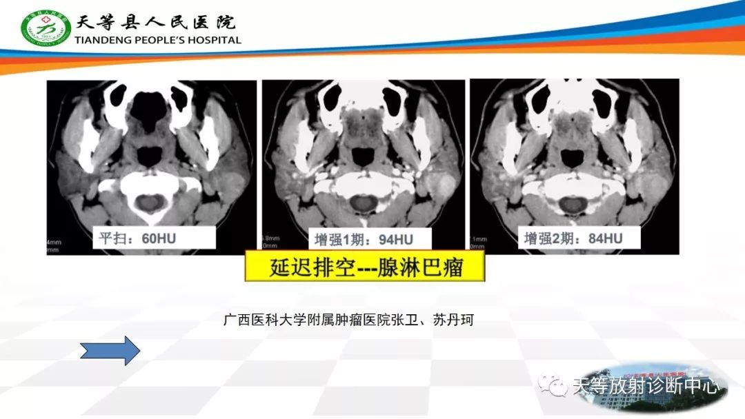 影像PPT - 【病例】腮腺Warthin瘤(腺淋巴瘤)1例CT影像-57 影像PPT - 【病例】腮腺Warthin瘤(腺淋巴瘤)1例CT影像-57