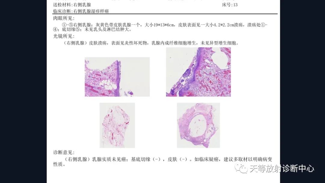 影像PPT - 【病例】乳腺Paget\'s病1例MR影像-10 影像PPT - 【病例】乳腺Paget\'s病1例MR影像-10