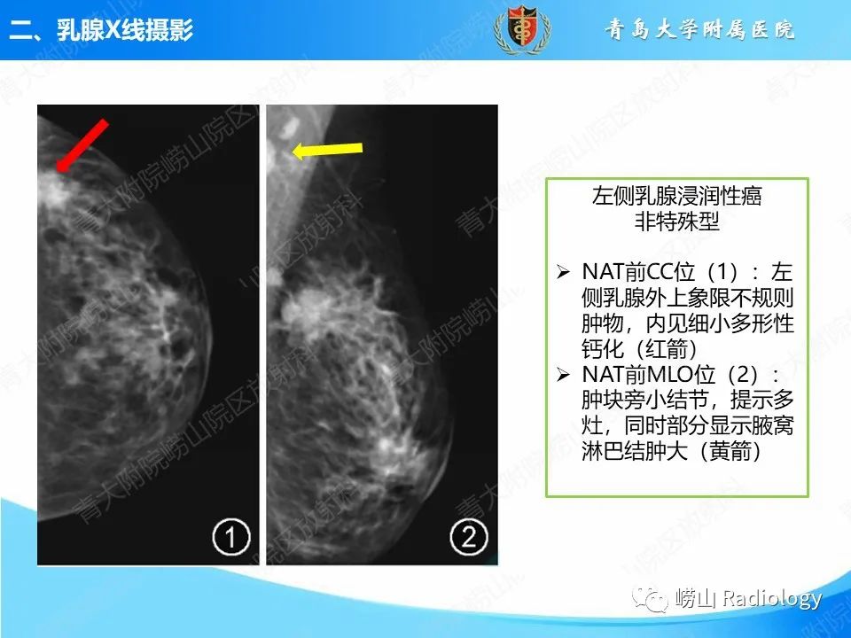 影像PPT - 【PPT】乳腺X线摄影及其延伸技术评估乳腺癌新辅助治疗效果-13