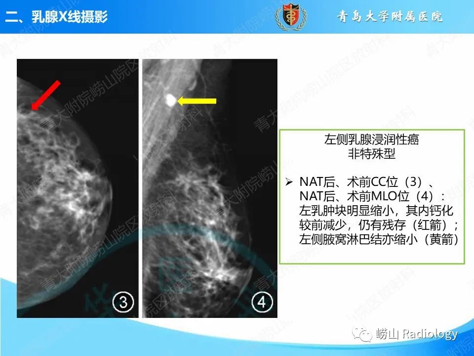 影像PPT - 【PPT】乳腺X线摄影及其延伸技术评估乳腺癌新辅助治疗效果-14