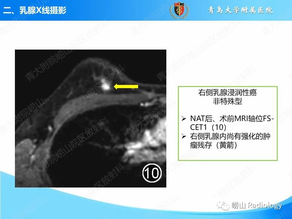 影像PPT - 【PPT】乳腺X线摄影及其延伸技术评估乳腺癌新辅助治疗效果-20