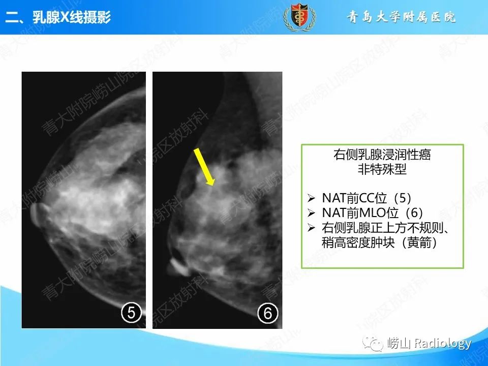 影像PPT - 【PPT】乳腺X线摄影及其延伸技术评估乳腺癌新辅助治疗效果-17