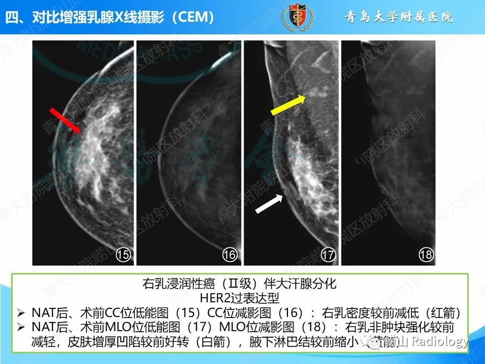 影像PPT - 【PPT】乳腺X线摄影及其延伸技术评估乳腺癌新辅助治疗效果-26