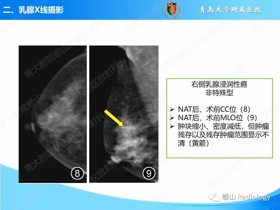 影像PPT - 【PPT】乳腺X线摄影及其延伸技术评估乳腺癌新辅助治疗效果-19