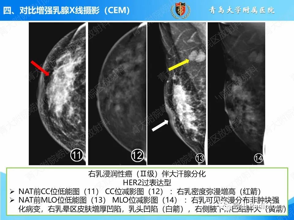 影像PPT - 【PPT】乳腺X线摄影及其延伸技术评估乳腺癌新辅助治疗效果-25