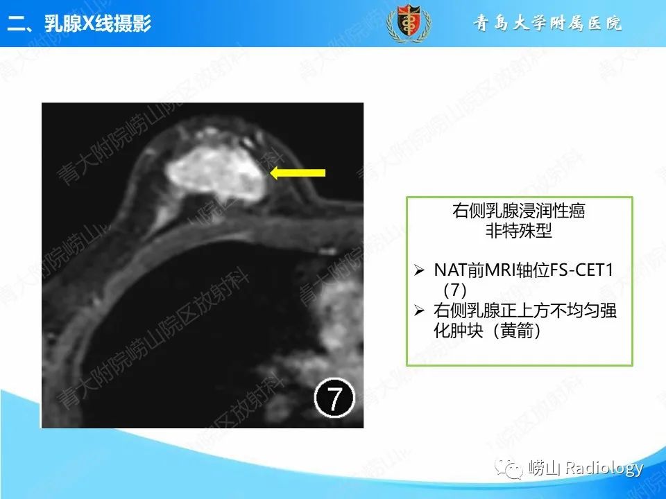 影像PPT - 【PPT】乳腺X线摄影及其延伸技术评估乳腺癌新辅助治疗效果-18