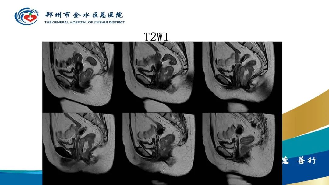 影像PPT - 【病例】直肠癌1例CT及MR影像诊断与鉴别-7