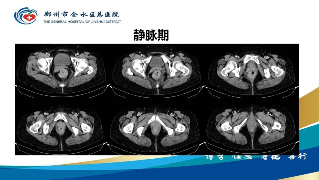 影像PPT - 【病例】直肠癌1例CT及MR影像诊断与鉴别-5