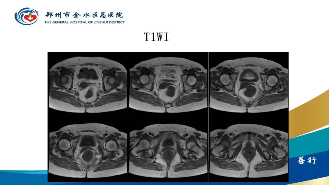 影像PPT - 【病例】直肠癌1例CT及MR影像诊断与鉴别-8