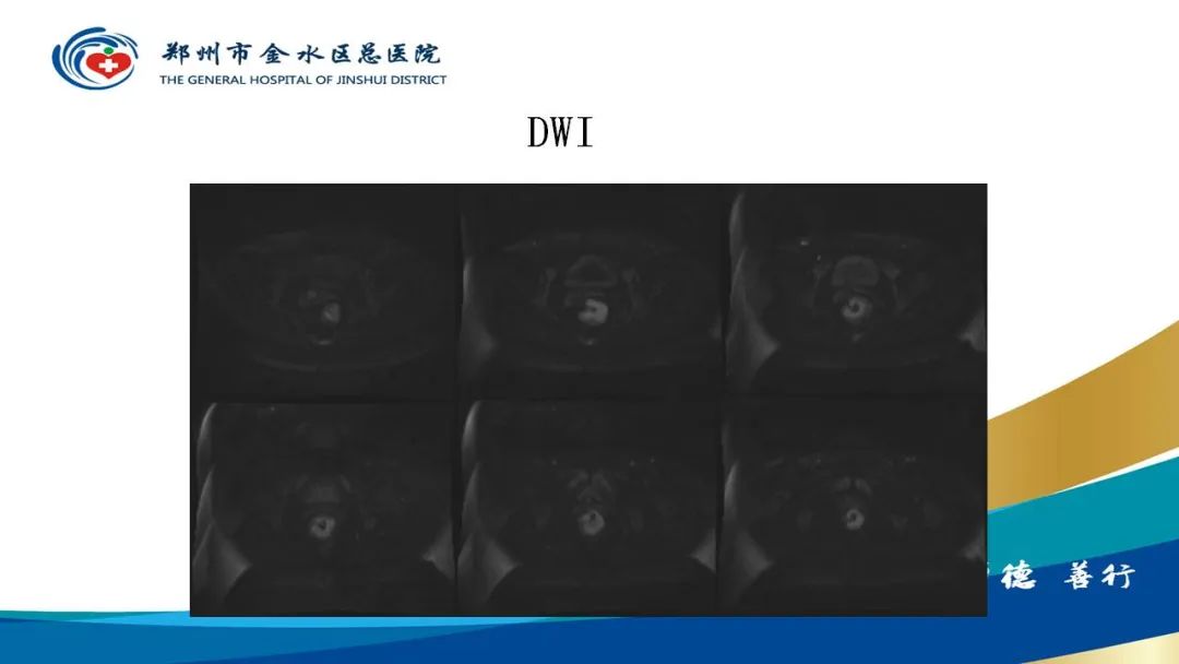 影像PPT - 【病例】直肠癌1例CT及MR影像诊断与鉴别-9