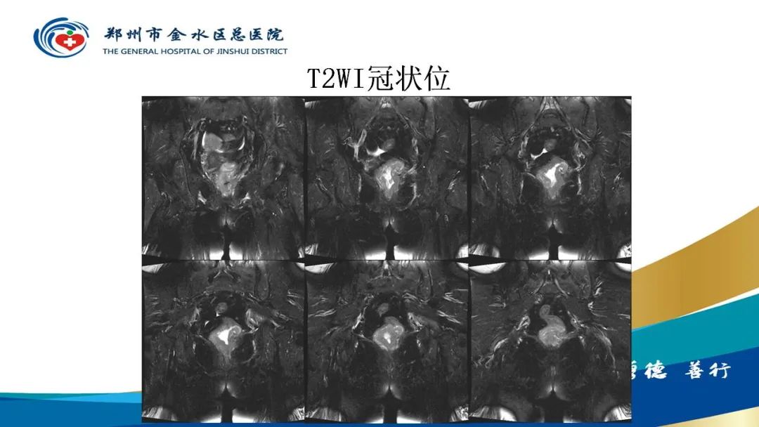 影像PPT - 【病例】直肠癌1例CT及MR影像诊断与鉴别-10