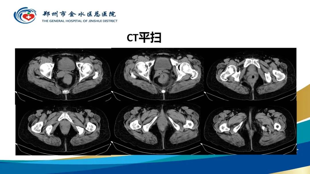 影像PPT - 【病例】直肠癌1例CT及MR影像诊断与鉴别-3