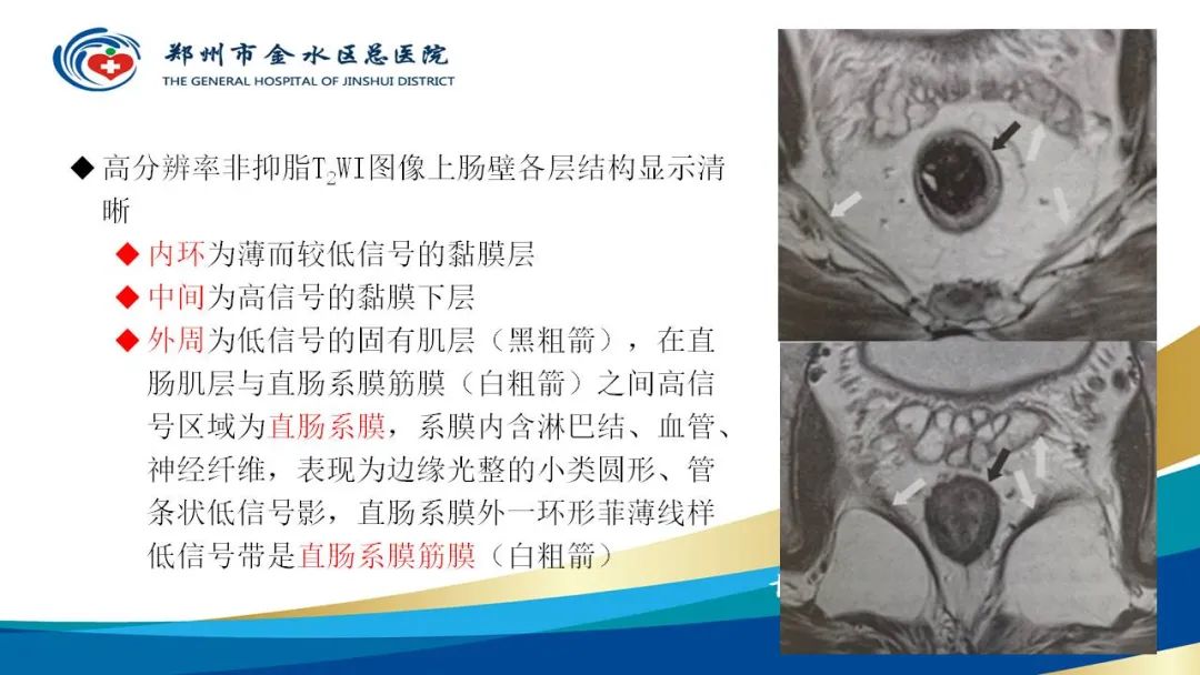 影像PPT - 【病例】直肠癌1例CT及MR影像诊断与鉴别-16