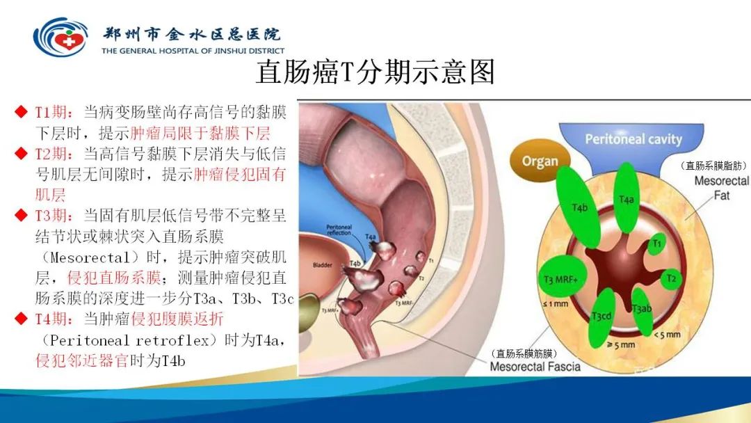 影像PPT - 【病例】直肠癌1例CT及MR影像诊断与鉴别-20