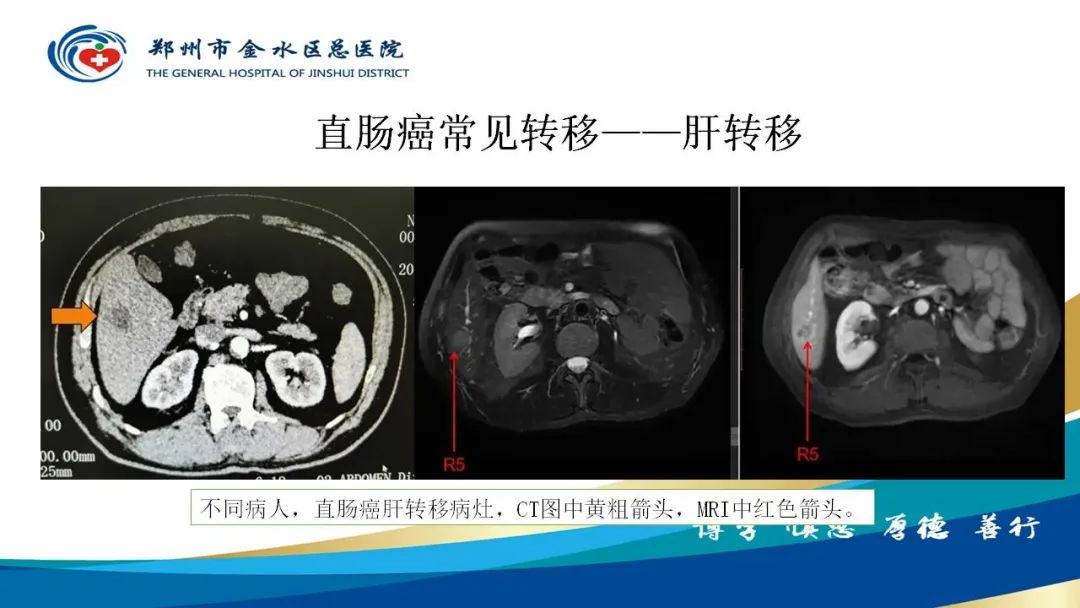 影像PPT - 【病例】直肠癌1例CT及MR影像诊断与鉴别-23