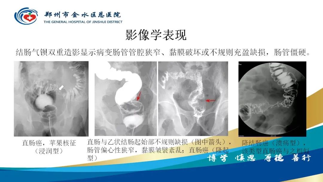 影像PPT - 【病例】直肠癌1例CT及MR影像诊断与鉴别-28