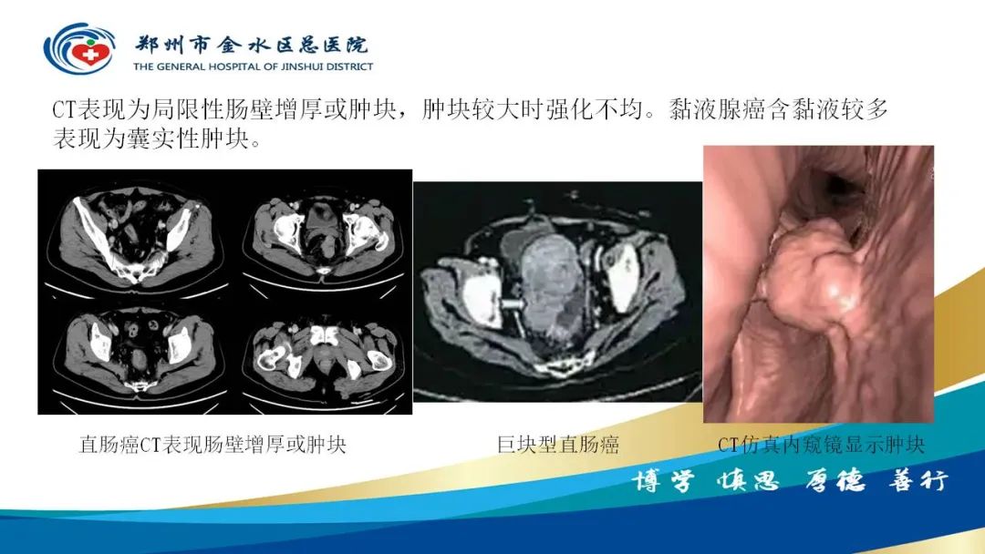影像PPT - 【病例】直肠癌1例CT及MR影像诊断与鉴别-29