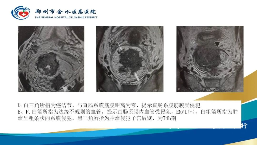 影像PPT - 【病例】直肠癌1例CT及MR影像诊断与鉴别-32