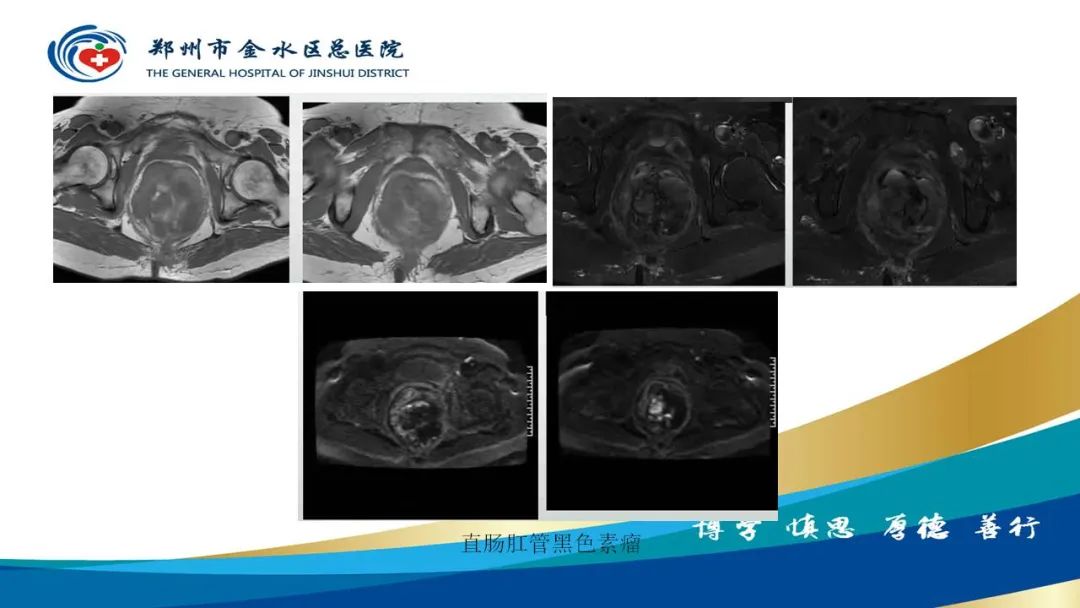 影像PPT - 【病例】直肠癌1例CT及MR影像诊断与鉴别-36