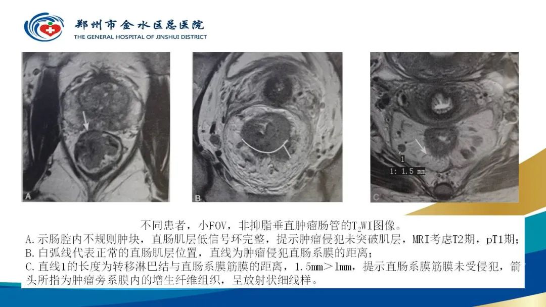 影像PPT - 【病例】直肠癌1例CT及MR影像诊断与鉴别-31