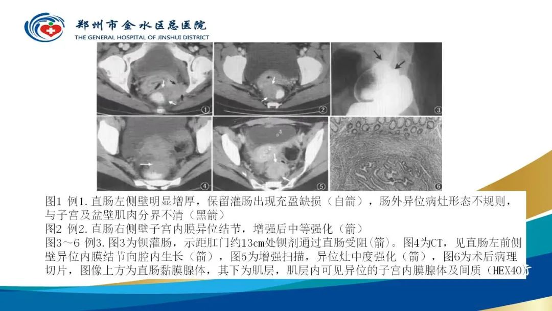 影像PPT - 【病例】直肠癌1例CT及MR影像诊断与鉴别-44