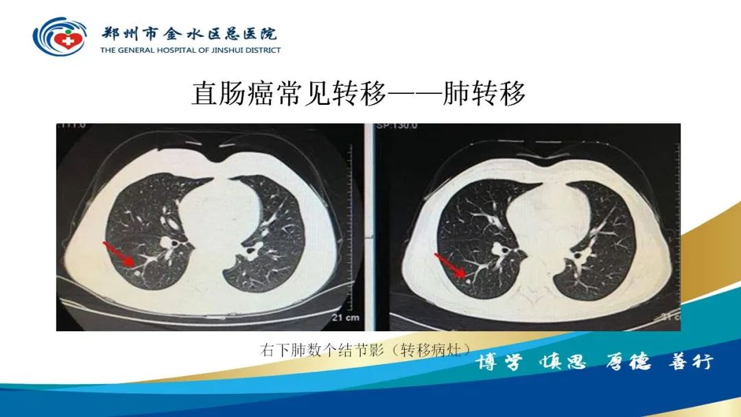 影像PPT - 【病例】直肠癌1例CT及MR影像诊断与鉴别-22