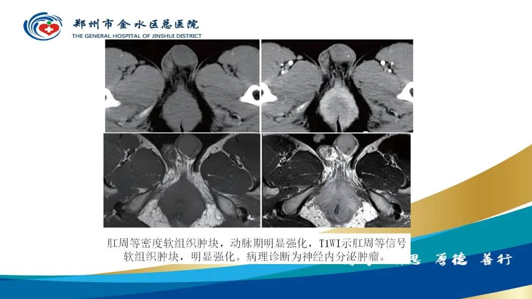 影像PPT - 【病例】直肠癌1例CT及MR影像诊断与鉴别-38