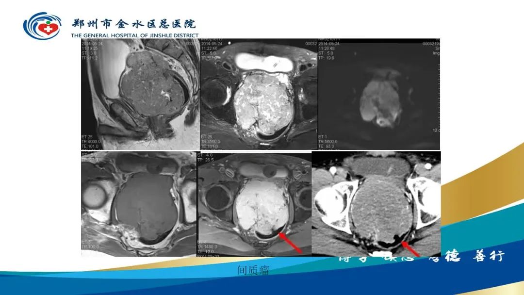 影像PPT - 【病例】直肠癌1例CT及MR影像诊断与鉴别-40