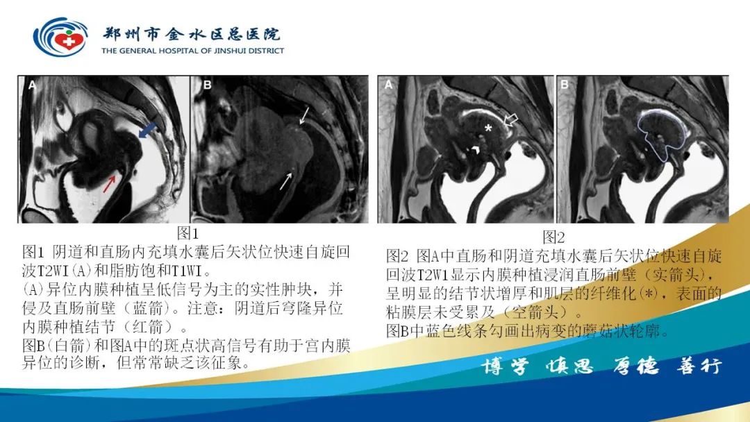 影像PPT - 【病例】直肠癌1例CT及MR影像诊断与鉴别-45