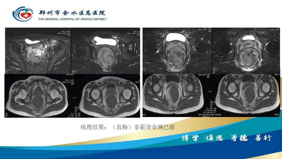 影像PPT - 【病例】直肠癌1例CT及MR影像诊断与鉴别-42