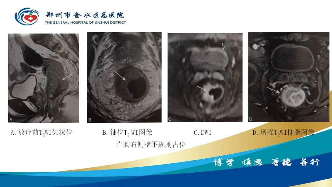 影像PPT - 【病例】直肠癌1例CT及MR影像诊断与鉴别-47