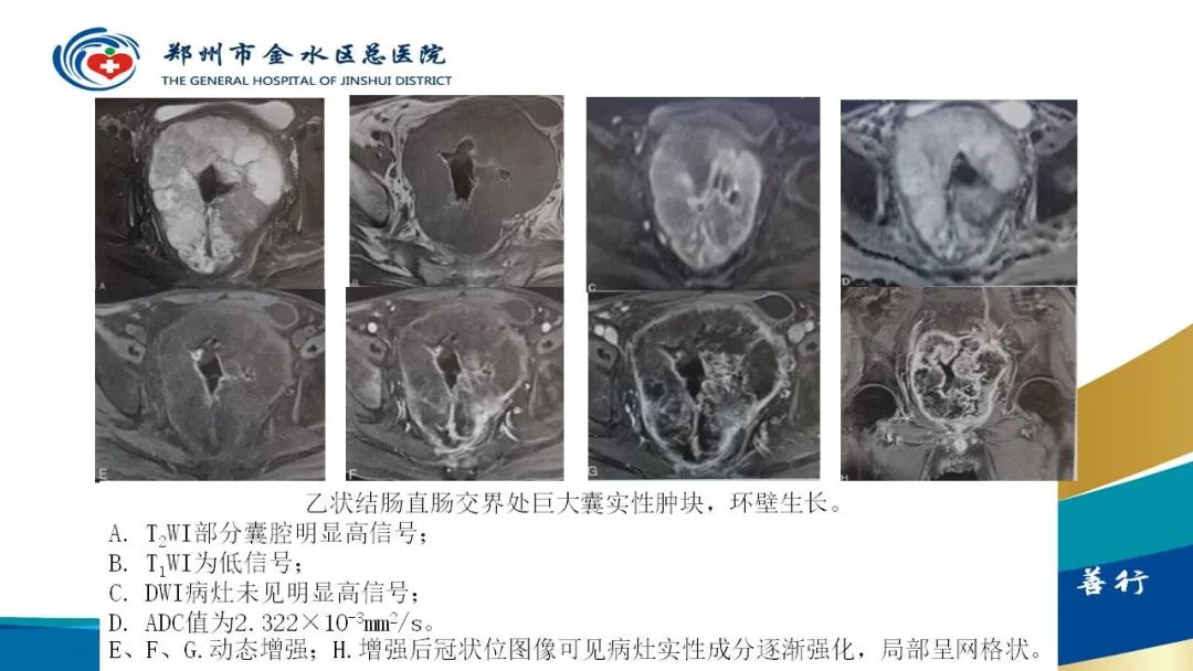 影像PPT - 【病例】直肠癌1例CT及MR影像诊断与鉴别-34