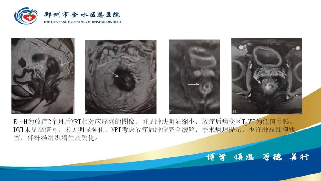 影像PPT - 【病例】直肠癌1例CT及MR影像诊断与鉴别-48