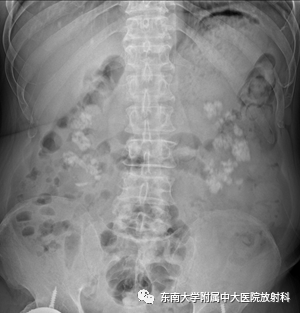 影像PPT - 【PPT】肾脏钙化性病变-1