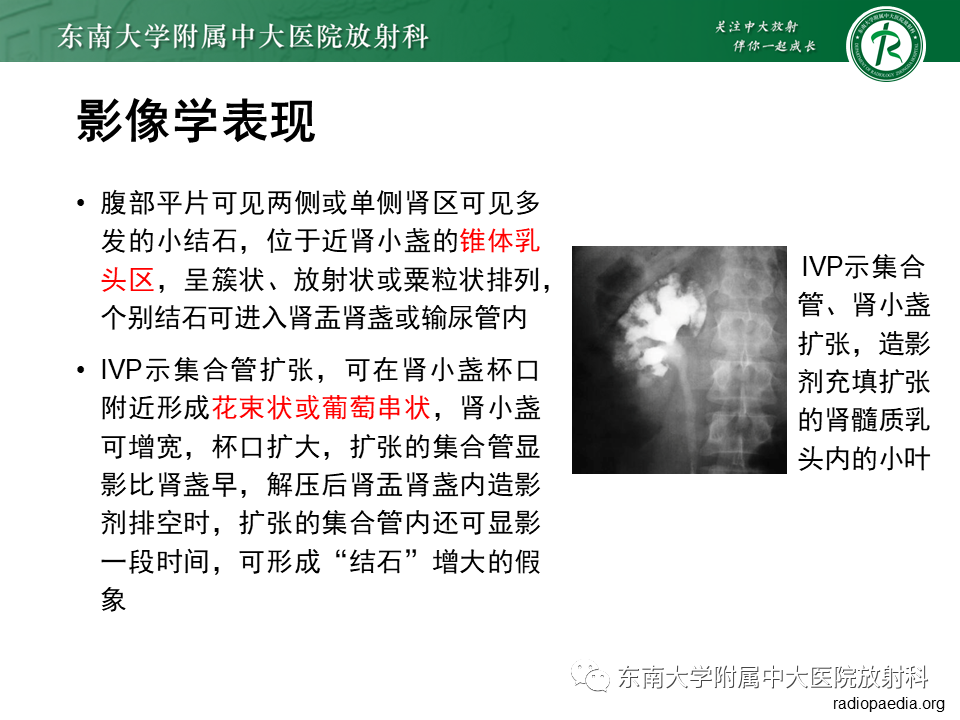 影像PPT - 【PPT】肾脏钙化性病变-8