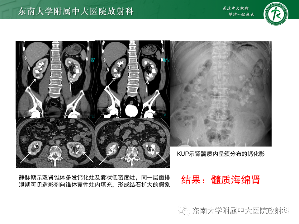 影像PPT - 【PPT】肾脏钙化性病变-3