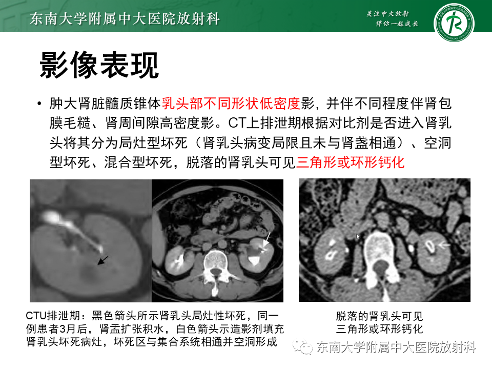 影像PPT - 【PPT】肾脏钙化性病变-11