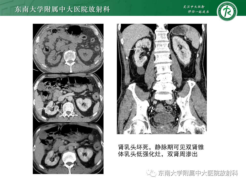 影像PPT - 【PPT】肾脏钙化性病变-14