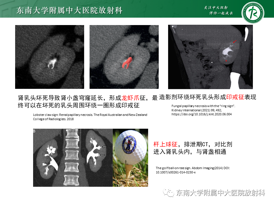 影像PPT - 【PPT】肾脏钙化性病变-12