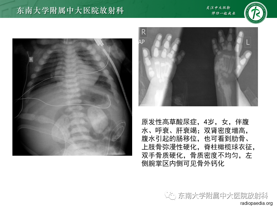 影像PPT - 【PPT】肾脏钙化性病变-18