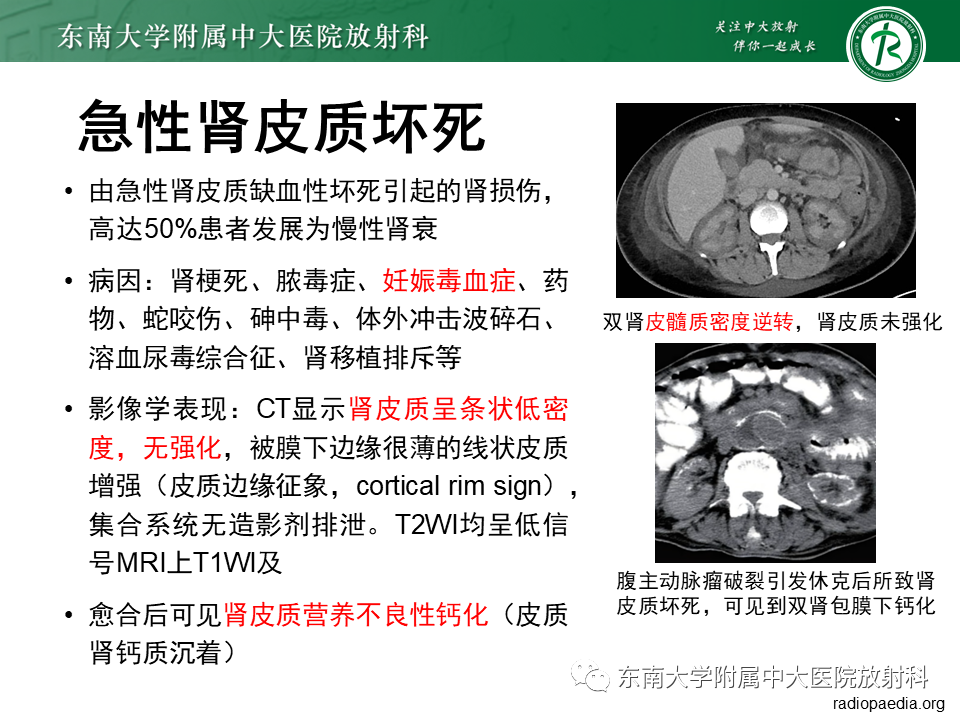 影像PPT - 【PPT】肾脏钙化性病变-19