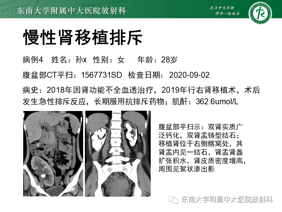 影像PPT - 【PPT】肾脏钙化性病变-23