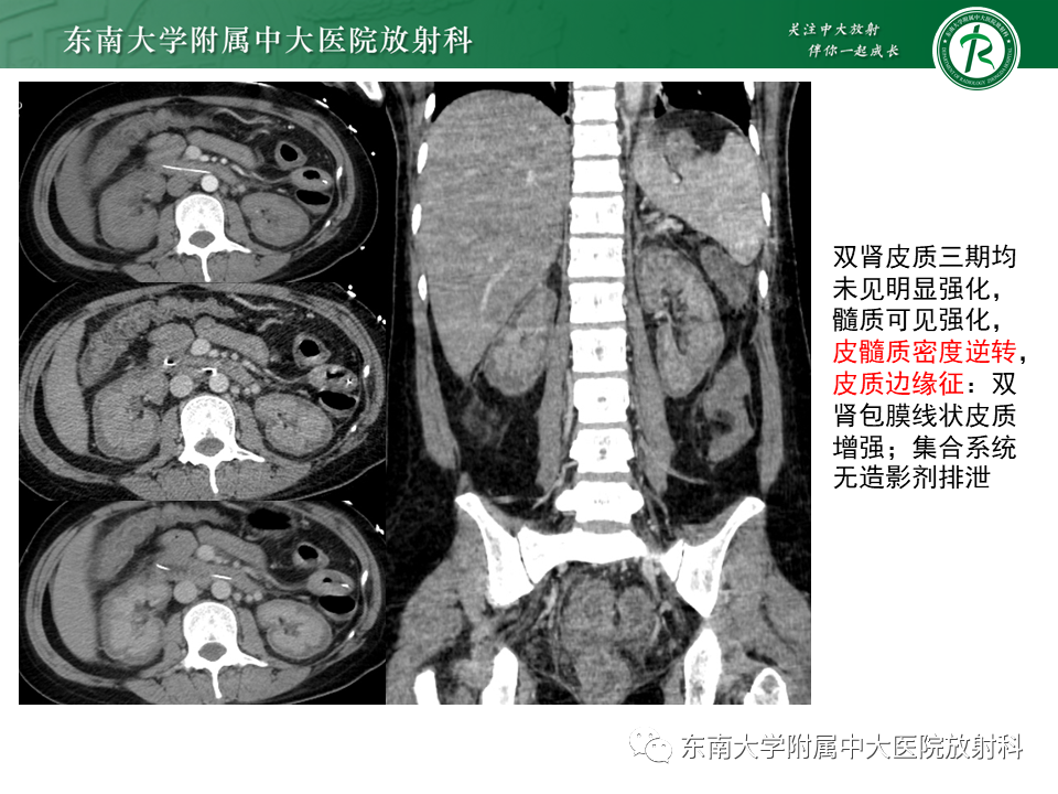 影像PPT - 【PPT】肾脏钙化性病变-21