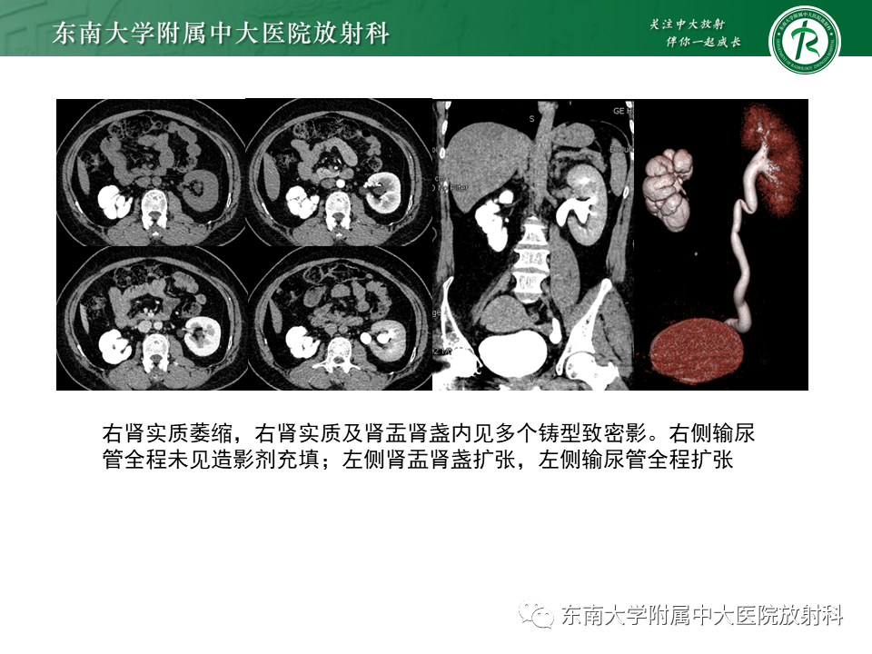 影像PPT - 【PPT】肾脏钙化性病变-28