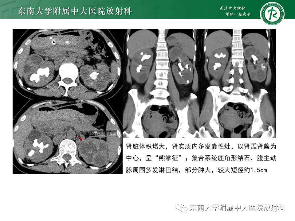 影像PPT - 【PPT】肾脏钙化性病变-32