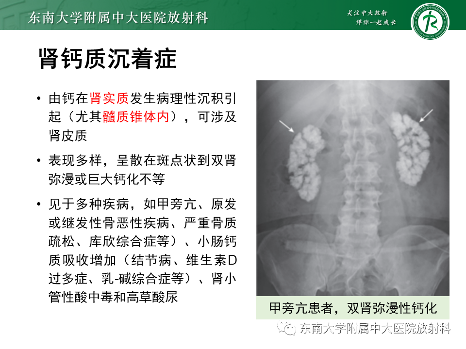 影像PPT - 【PPT】肾脏钙化性病变-33
