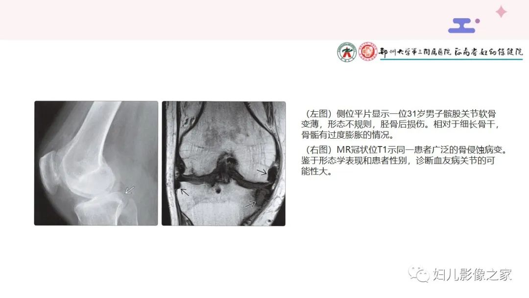 影像PPT - 【PPT】血友病关节病的影像学表现-11