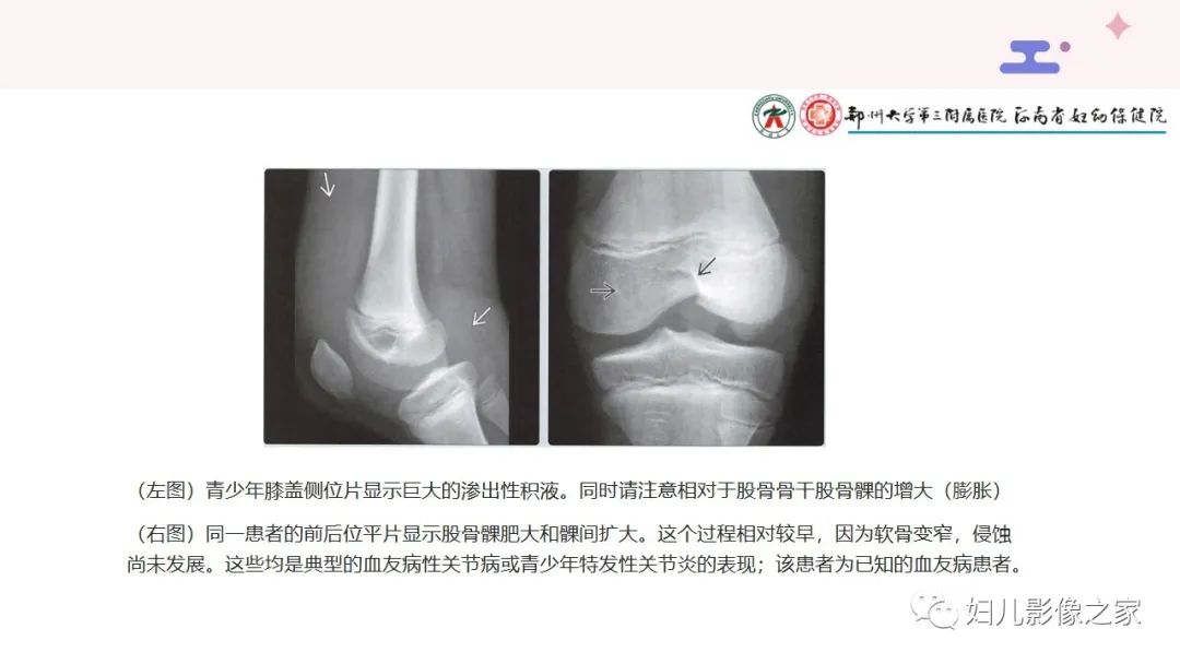 影像PPT - 【PPT】血友病关节病的影像学表现-10