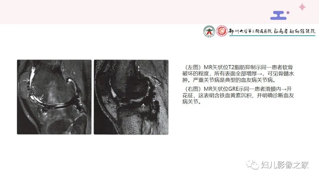影像PPT - 【PPT】血友病关节病的影像学表现-12